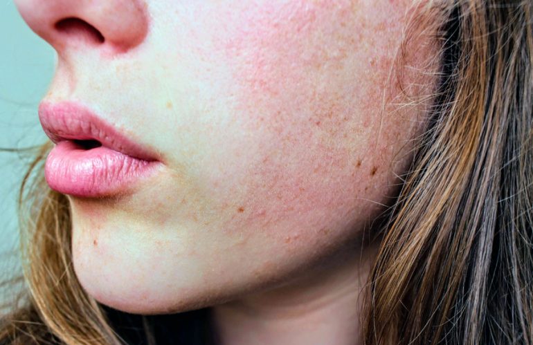 How To — Soothe Heat-Related Rashes