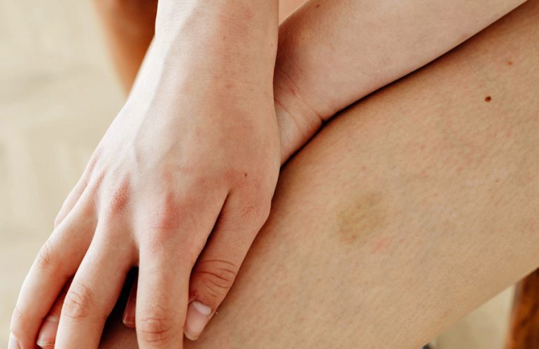 How To — Prevent Thigh Chafing