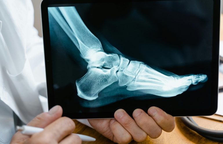 Foot Disorders