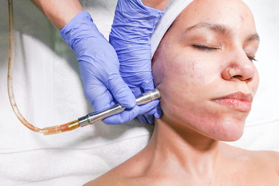 Microdermabrasion Aftercare
