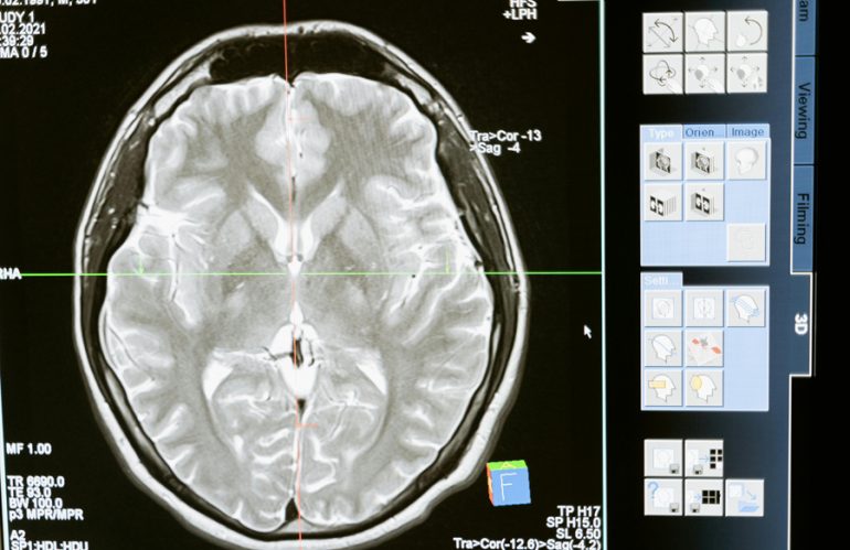 About the Pineal Gland